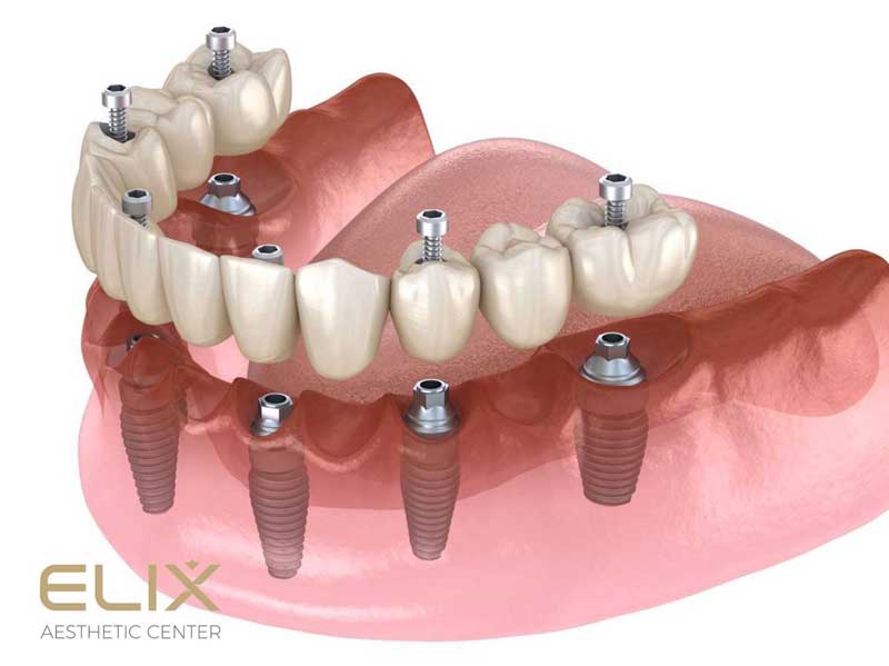 Отёк после имплантации зубов